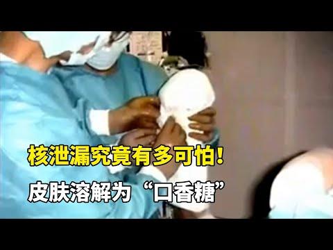 核輻射究竟有多可怕！看完這些人的慘狀，妳就會明白爲何全世界都反對，日本向海裏傾倒核廢水！