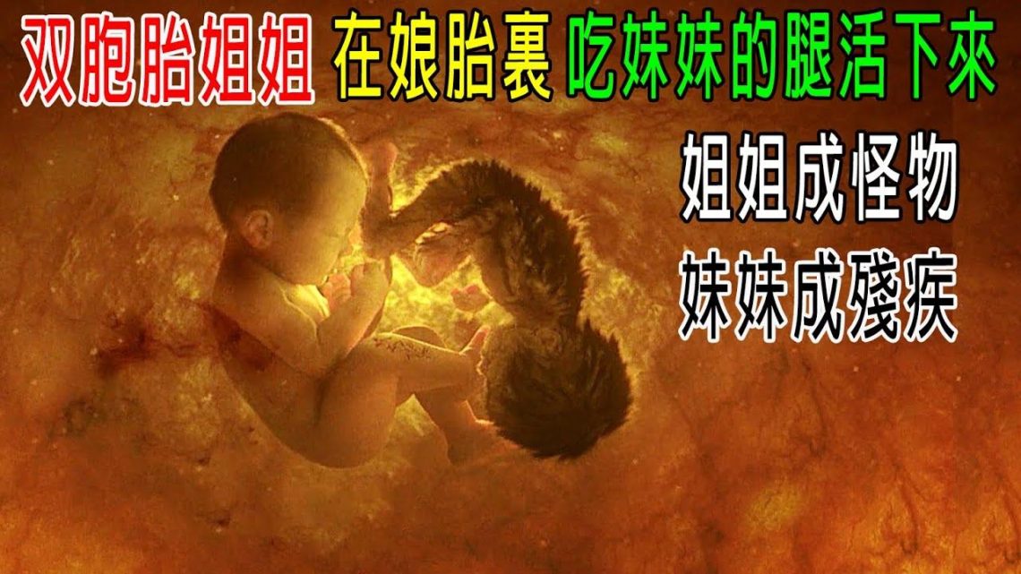 雙胞胎姐姐，在娘胎裏吃妹妹腿活下來，生下后姐姐成了怪物，妹妹成殘疾！